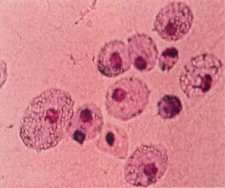 图2-33 组织细胞(泡沫细胞)